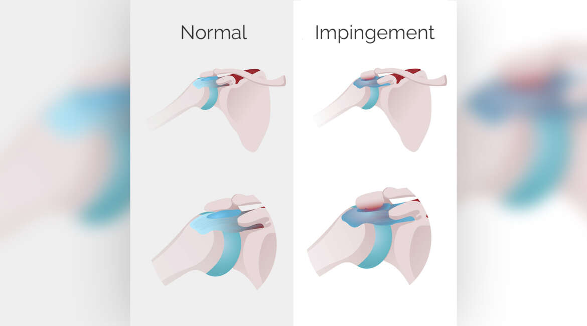 L’Impingement Sub-Acromiale