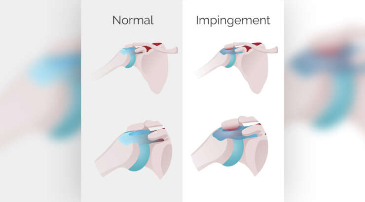 L’Impingement Sub-Acromiale