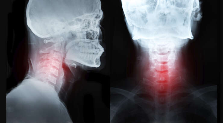 Il Dolore Cervicale